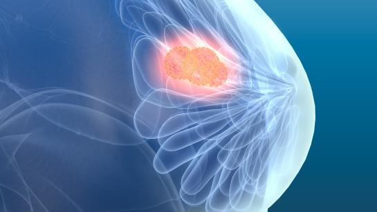 Visualisation of breast cancer