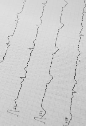 EKG print